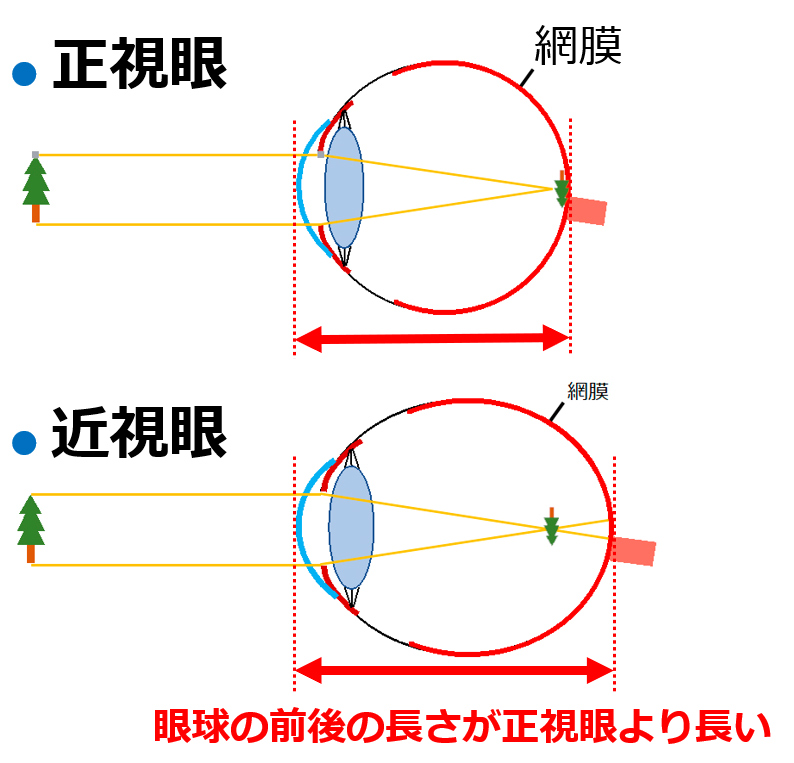 眼球の前後の長さが正視眼より長い