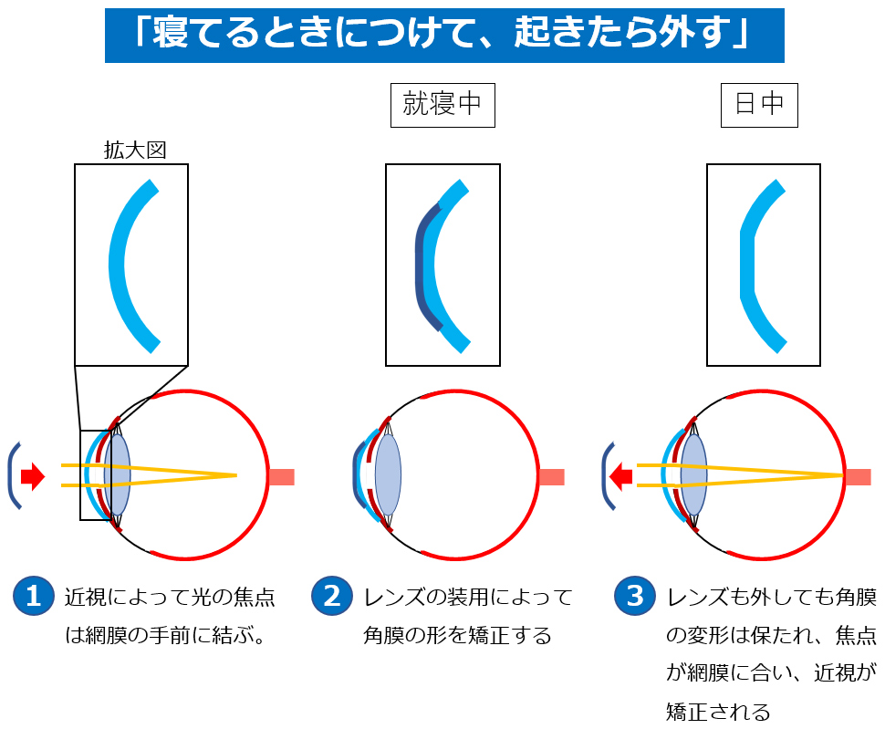 「寝てるときにつけて、起きたら外す」