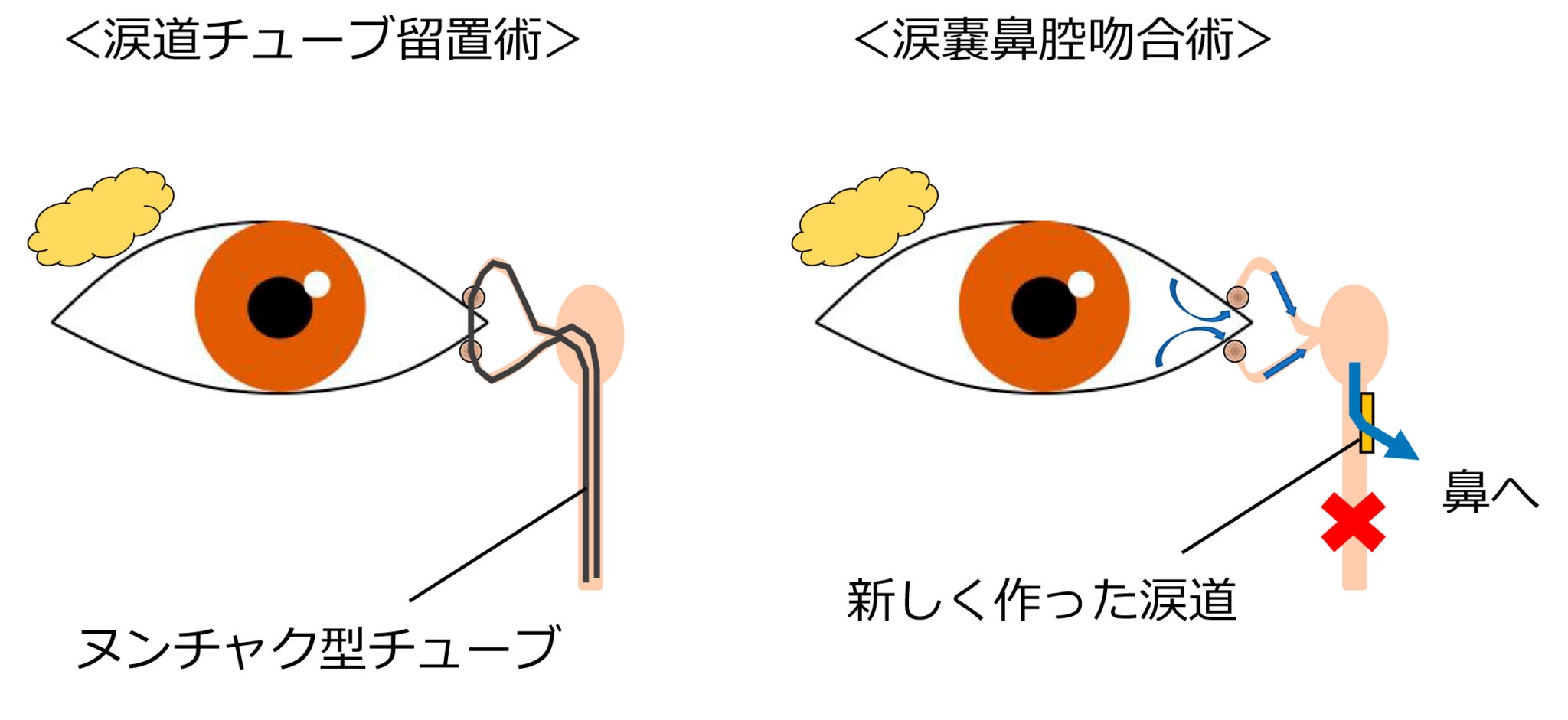 涙嚢炎とは何ですか?