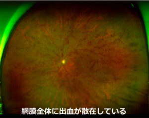 網膜中心静脈閉塞症の眼底写真
